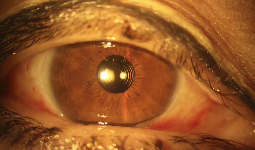 Ojo con lente intraocular
